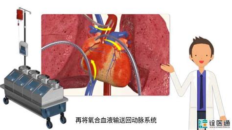 3D动画带您了解心脏室间隔缺损手术的全过程