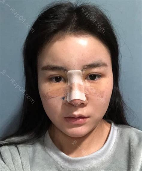 北京美雅枫整形医院做隆鼻手术全过程记录~来看看手术前后差别多-欣美整形网