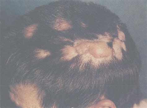 脓肿性穿掘性头皮毛囊周围炎-皮肤病临床与病理-医学
