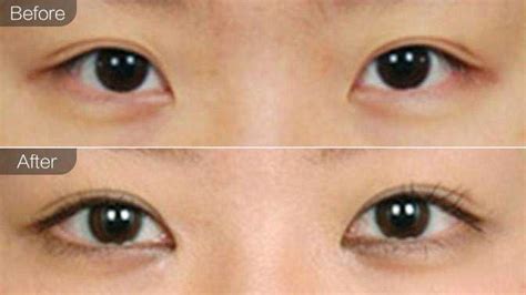 【一张图告诉你开眼角和不开眼角的区别】有患者问单眼皮做双眼皮手术就可以了_圈子-新氧美容整形