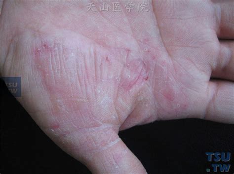 丘疹型白色糠疹_白色糠疹_北京京城皮肤医院(北京医保定点机构)