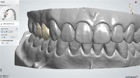 口腔活动义齿支架制作_设计_数字化_牙冠