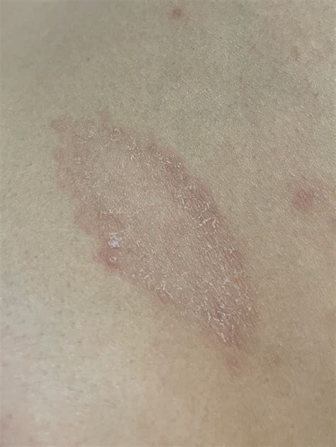 皮肤出现一个环状红圈,空心环状湿疹,身上出现圆圈斑图片_大山谷图库