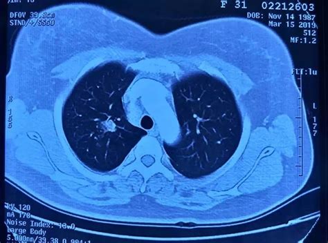 肺上的结节是怎样产生的，肺结节是怎么引起的？