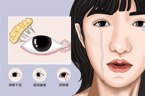 流泪与溢泪有什么区别？如何治疗泪道病？_上海希玛瑞视眼科医院