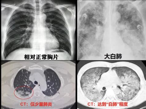 CT影像出现“白色”就是“白肺”？重型肺炎预警信号有哪些？——上海热线HOT频道