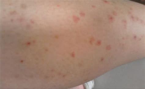 夏天腿上长了很多痘还泛红，不时的很痒，请问这是什么情况，有治疗的的方法吗？ - 知乎