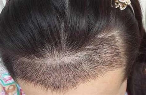 种植头发一般要多少钱?种植头发能管多长时间?_千颜网