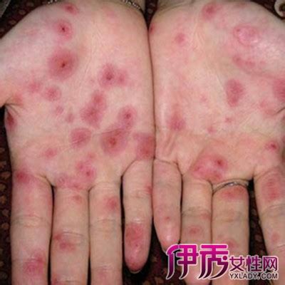 二期梅毒图片