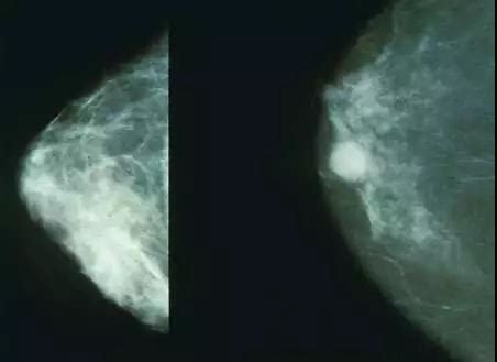 一张表搞懂乳腺囊性增生病和乳腺纤维腺瘤的区别！