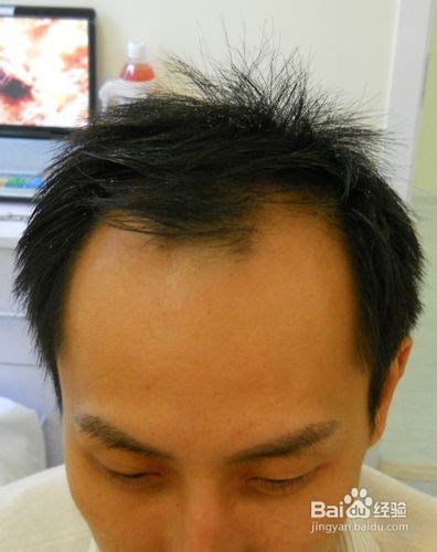 脱发类型有哪些？脱发如何治疗？ – 生发垂直网
