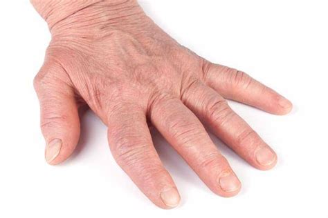 手指莫名出现杵状指，或是肺癌到来的信号，及时检查肺CT_患者