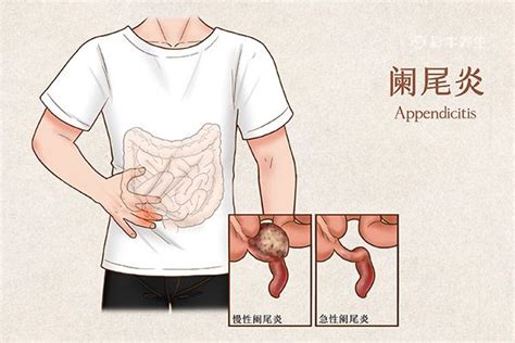 阑尾炎疼痛位置图图片