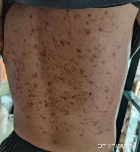 搭背疮初期图片