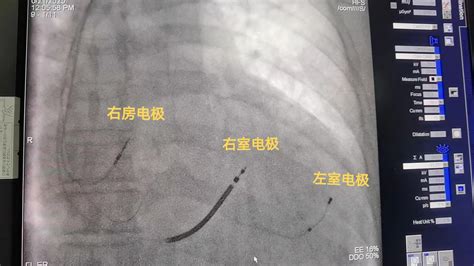 医邦网-医学资讯-【宁陕县医院】完成首例临时心脏起搏器植入手术