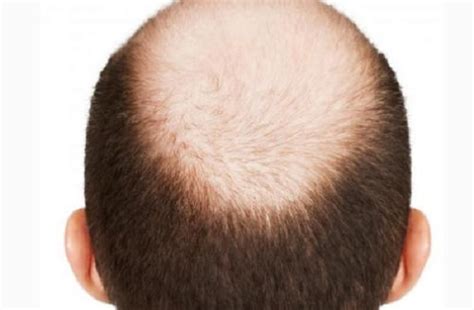 头发如何种植，头发种植可以保持多久，植发后还会脱发吗？__凤凰网