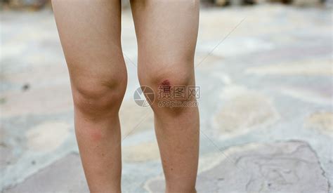 膝盖磕伤高清图片下载-正版图片501535461-摄图网