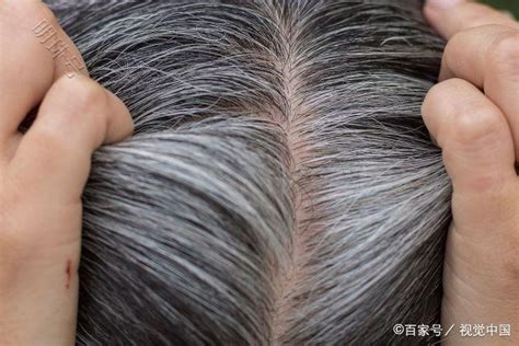 维生素B12和叶酸的缺乏为什么会导致白头发？一文解答_资讯频道_东方养生