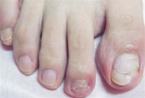 大脚趾灰指甲的初期症状图片_有来医生