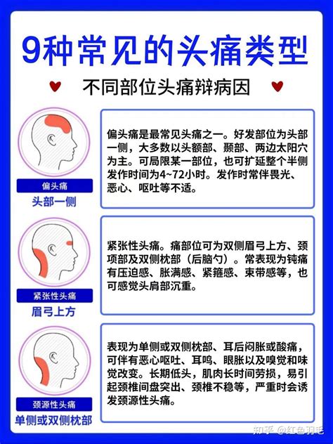 9种常见的头疼类型 - 知乎