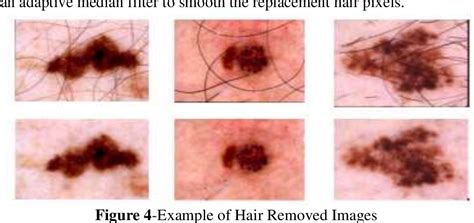 Figure 7 from A Prediction of Skin Cancer using Mean-Shift Algorithm ...