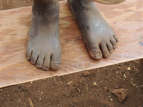 实拍非洲“烂脚病”，脚板千疮百孔只因没鞋穿