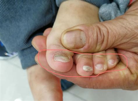 指甲变灰就是得了灰指甲？真正的灰指甲有这些症状→|感染_新浪新闻