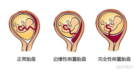 怀孕后，胎盘前壁后壁有什么区别？这种位置很危险，孕妇要多注意
