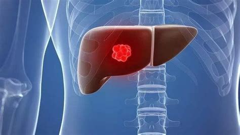 人体肝脏病变图片素材-正版创意图片401806015-摄图网