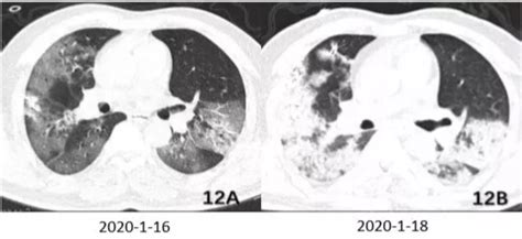 图解：新型冠状病毒肺炎的影像学表现 - 丁香园