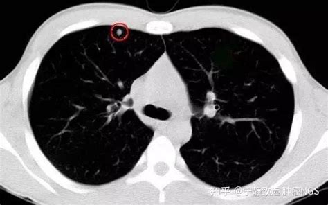 体检发现肺部小结节，是肺癌吗？ - 知乎
