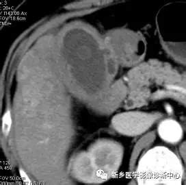 胆囊壁毛糙需要治疗吗？ - 知乎