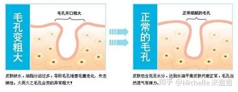 应对毛孔粗大最详解决方法 - 知乎