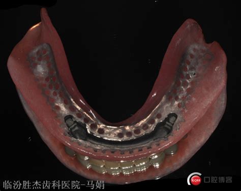 全口义齿病例（附视频）-宁波朱静峰的博客-KQ88口腔博客