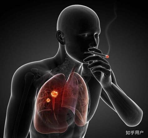 警惕！肺纤维化患者肺癌发病率是正常人群的5-20倍！-科普头条-看呼吸