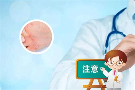 圆形皮疹图片