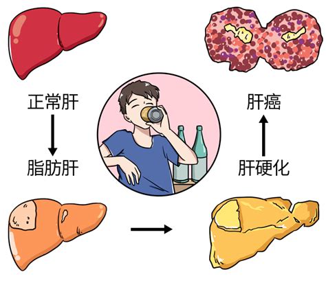 【世界肝炎日】了解“甲乙丙丁戊”，保护“小心肝”！_桂平市中医医院