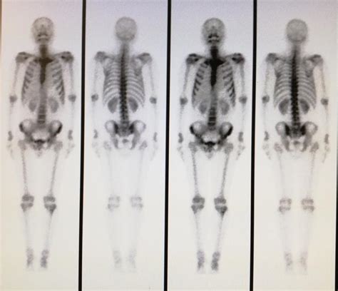 核医学科检查全身骨显像检查流程_腾讯视频