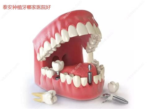 泰安种植牙哪家医院好,牙博士/和睦口腔种牙排名前十 - 口腔资讯 - 牙齿矫正网