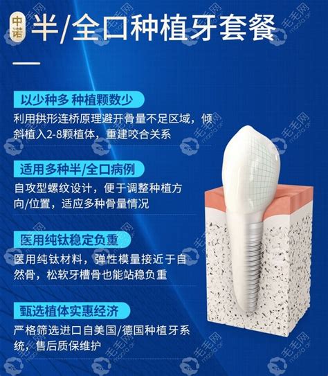 这份北京牙管家口腔价格表了解下全口allon4种植牙贵不贵 - 种植牙 - 炫美网