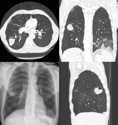【科普】怎么能早期发现肺癌
