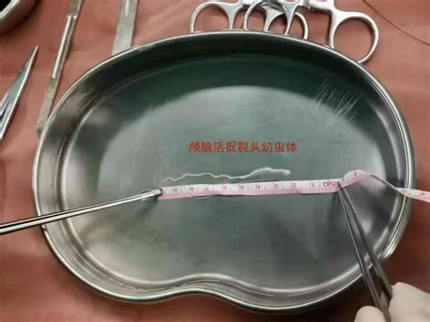 裂头蚴寄生虫图片