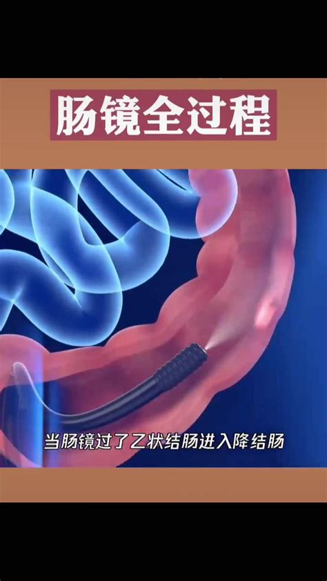 为什么体检最好把胃镜肠镜一起做？_潍坊市市立医院(官方网站)