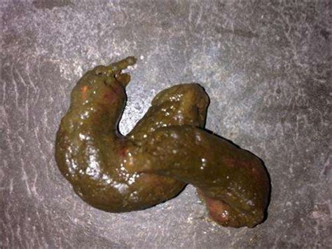 暗红色便血图片