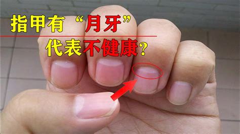指甲上的月牙大小和什么有关？-北京安达医院