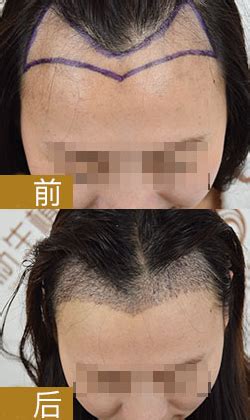江苏植发案例-种植头发-对比效果图-发友网