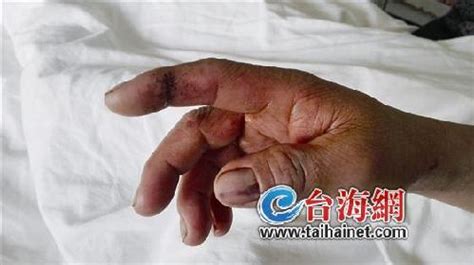 广西一72岁男子被剧毒眼镜王蛇咬伤，紧急送到南宁抢救！