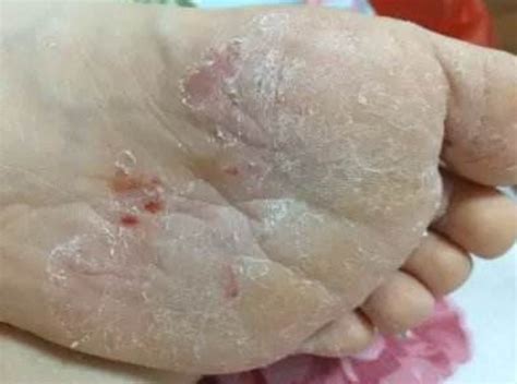 脚面发黑图片