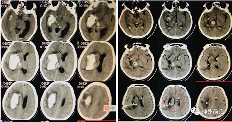 脑出血的CT及MR分期及表现