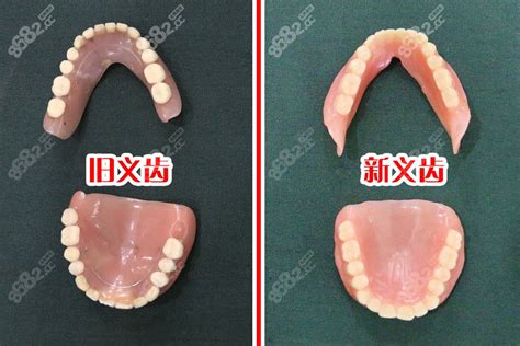 缺几颗牙才能做吸附性义齿?有人说BPS吸附性义齿要拔光牙齿,牙齿修复-8682赴韩整形网